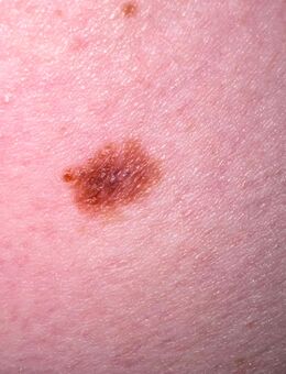 Hautscreening - Nürnberg