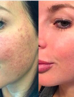 Microneedling o.BBglow Behandlung o.Schulung - Voerde (Niederrhein)