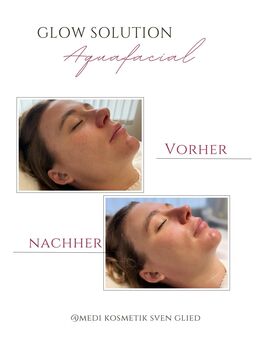 Glow Solution Aquafacial Kosmetikbehandlung - Iserlohn