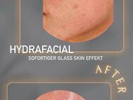 Hydrafacial Modelle - Hösbach