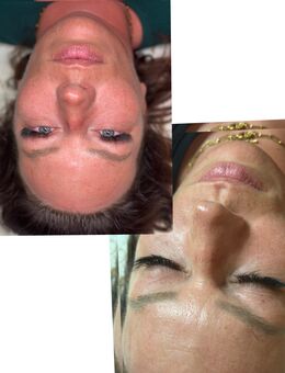 Microneedling & BB Glow - Vreden Zentrum
