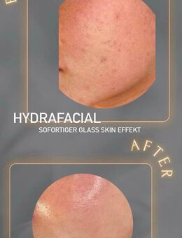 Hydrafacial Modelle - Hösbach