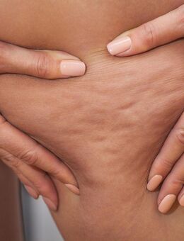 Anti Cellulite Massage - Iserlohn