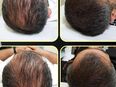 Haarverdichtung, Haarausfall, Kopfpigmentierung Haare in 68165