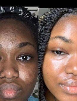 afrikanische schwarze Seife Haut Haare Akne Reinigung 200g - Schwabach