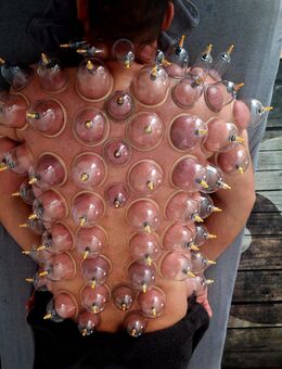 Schröpfen bzw. Schröpfmassage : Tradition trifft moderne Körperarbeit - Blieskastel