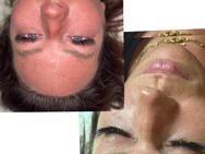 Microneedling & BB Glow - Vreden Zentrum