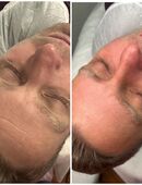 Aqua Facial/Gesichtsbehandlung/Hydrodacial in 48691